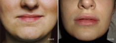 Augmentation des lèvres par Permalip - Cliché avant
