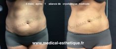 Cryolipolyse - Cliché avant - Dr AMAT - ????Greffe FUE 2.0 Medic Xpert