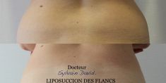 Liposuccion - Cliché avant - Dr Sylvain David