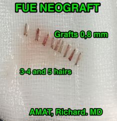 Dr Richard Amat Centre de Micro-greffe de cheveux FUE - Cliché avant - Dr Richard Amat Centre de Micro-greffe de cheveux FUE