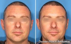 Lifting du visage - Cliché avant - Dr Franck Benhamou