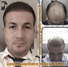 Greffe de cheveux par FUE - Cliché avant - Centre Capillaire Villa La Tour