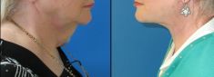 Lifting du visage - Le lifting du cou peut nécessiter une cicatrice sous le menton. Dans ce cas, pas de cicatrices visibles sous le menton, uniquement au pourtour des oreilles.