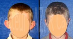 Dr Calin Constantin LAZAR - Correction voie ouverte à cicatrice rétro-auriculaire (enfant)