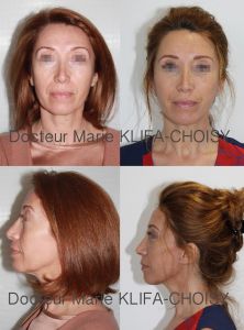 Dr Marie Klifa-Choisy - lifting du visage