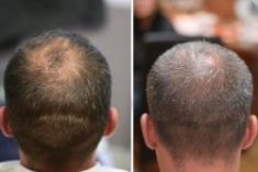 Greffe de cheveux - Cliché avant - Dr. Paul Benet