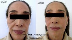 Dr Marilyne Plasqui - Traitement complet du visage par injections de produits de comblements (pli d