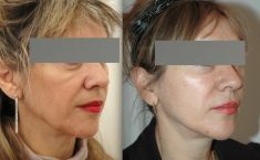 Lifting du visage - Lifting associant un lifting medio facial et un lifting cervico facial dans la même procedure
