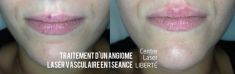 Traitements laser - dermatologie esthétique - Cliché avant - Dr Fabien Giausseran