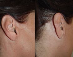 Lifting du visage - Cicatrices devant et derrière l’oreille