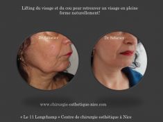 Lifting mammaire (Mastopexie) - Cliché avant - Dr Henry Sabatier