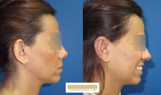 Otoplastie (Chirurgie esthétique des oreilles) - Cliché avant - Dr Vincent Nguyen