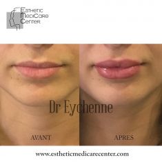 Augmentation des lèvres (acide hyaluronique) - Cliché avant - Dr Catherine Eychenne