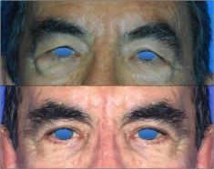 Blépharoplastie - Cliché avant - Dr Alexandre Mertens