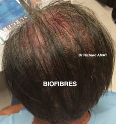 Traitements de la chute des cheveux - Cliché avant - Dr AMAT - ????Greffe FUE 2.0 Medic Xpert