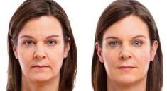 Mésothérapie, regénération du visage et du cou - Cliché avant - Dr Franck Benhamou