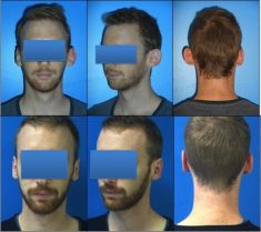 Otoplastie (Chirurgie esthétique des oreilles) - Cliché avant - Dr Alexandre Mertens