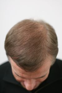 Traitements de la chute des cheveux - Cliché avant