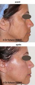 Lipofilling ou autogreffe de tissu graisseux - Cliché avant - Dr Yohann Derhy