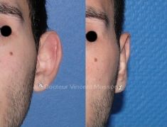 Otoplastie (Chirurgie esthétique des oreilles) - Cliché avant - Dr Vincent Masson