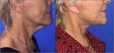 Lifting du visage - Cliché avant - Dr Alexandre Mertens
