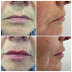 Augmentation des lèvres (acide hyaluronique) - résultat immédiat au Volbella
une réaction inflammatoire peut survenir dans les 48 heures qui suivent.
Remarquez la commissure labiale qui s