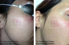 Traitements laser - dermatologie esthétique - Cliché avant - Dr Fabien Giausseran