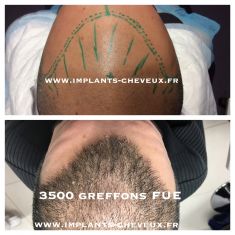 Greffe de cheveux - Cliché avant - Dr Richard Amat Centre de Micro-greffe de cheveux FUE