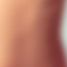 Augmentation et modelage des fesses et des hanches - Resultat de BRAZILIAN BUTT LIFT ? Le Brazilian Butt Lift (lifting des fesses brésilien ou lipomodelage gluteal) permet un changement définitif de la silhouette. Il consiste à greffer de la graisse prélevée sur les poignets d