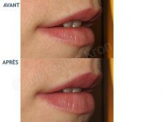 Augmentation des lèvres - Cliché avant - Dr Cédric Kron
