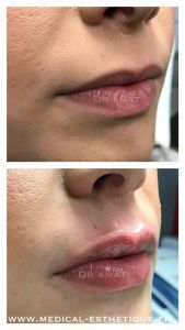 Augmentation des lèvres (acide hyaluronique) - Cliché avant - Dr. Richard Amat