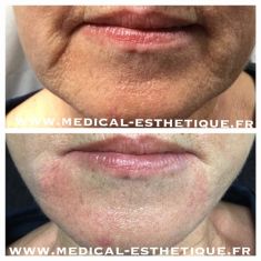Ultherapy ou Ulthera - Cliché avant - Dr AMAT - ????Greffe FUE 2.0 Medic Xpert