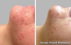 Traitement acné - laser - Cliché avant - Dr Franck Benhamou