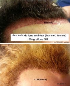 Greffe de cheveux - Cliché avant - Docteur GRANGÉ-PRADERAS