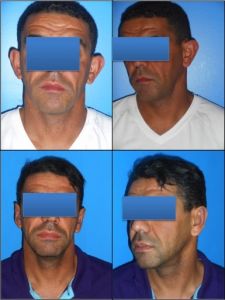 Otoplastie (Chirurgie esthétique des oreilles) - Cliché avant - Dr Alexandre Mertens