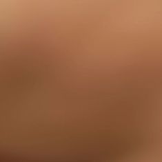 Augmentation et modelage des fesses et des hanches - Resultat de BRAZILIAN BUTT LIFT ? Le Brazilian Butt Lift (lifting des fesses brésilien ou lipomodelage gluteal) permet un changement définitif de la silhouette. Il consiste à greffer de la graisse prélevée sur les poignets d