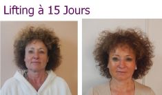 Lipofilling du visage - Cliché avant - Dr Laurent Benadiba M.D