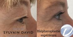 Blépharoplastie - Cliché avant - Dr Sylvain David