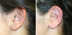 Otoplastie (Chirurgie esthétique des oreilles) - Cliché avant - Dr Xavier Tenorio
