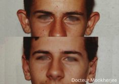 Otoplastie (Chirurgie esthétique des oreilles) - Cliché avant - Dr Robin Mookherjee