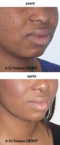 Augmentation des lèvres - Cliché avant - Dr Yohann Derhy