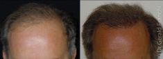 Greffe de cheveux - Cliché avant - Dr Gérald Franchi MD