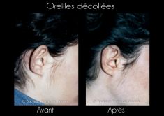 Otoplastie (Chirurgie esthétique des oreilles) - Cliché avant - Dr Pierre de Taddeo