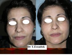 Lipofilling ou autogreffe de tissu graisseux - Cliché avant - Dr Tayeb Essadok