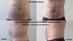 CoolSculpting - Traitement du gras abdominal par Coolsculpting (2 Zones), résultats définitifs à 4 mois