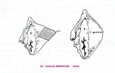 Vaginoplastie - Cliché avant - Dr Laurent Benadiba M.D