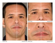Traitement galvanique (Nu Skin Galvanic spa system ™ )  – revitalisation de la peau - Cliché avant - Dr Franck Benhamou