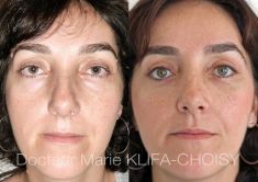 Dr Marie Klifa-Choisy - http://www.chirurgie-esthetique-nice.fr/chirurgie-esthetique/chirurgie-du-visage/blepharoplastie-chirurgie-des-paupieres/http://www.chirurgie-esthetique-nice.fr/chirurgie-esthetique/chirurgie-du-visage/blepharoplastie-chirurgie-des-paupieres/
