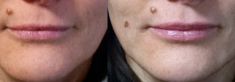 Augmentation des lèvres (acide hyaluronique) - Cliché avant - Dr Romain Tourniaire