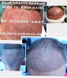 Greffe de cheveux - Cliché avant - Dr AMAT - Micro-greffe cheveux FUE 2.0